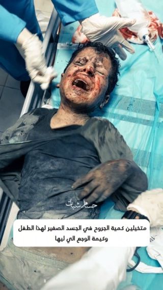 متخيلين كمية الجروح في الجسد الصغير لهذا الطفل 
يالله يالله...