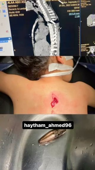 She is a little child !!!
Alaa is an innocent girl that was playing in front of her tent, when she was shocked with a bullet inside her back enforcing her to be paralyzed after the bullet cuts her...